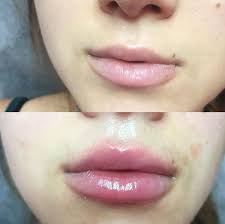 Comment en prendre soin au quotidien ? Injections Aux Levres 8 Choses A Savoir Avant De Se Faire Grossir Les Levres