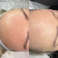 Image result for Sebaceous Hyperplasia