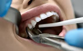 Image result for Tooth Extraction