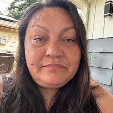 17-year-old Landon Daesch received a heart transplant this week, but  complications have left him