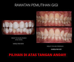 Dental crown atau crown gigi merupakan prosedur pemasangan selubung gigi di atas gigi yang rusak. Harga Crown Gigi Klinik Kerajaan