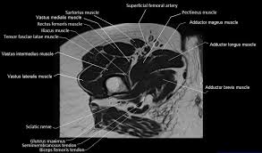 Want to learn more about it? Mri Anatomy Of Hip Joint Free Mri Axial Hip Anatomy