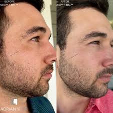 MOXI +BBL is an amazing laser combination for anyone and any type of skin!  MOXI can treat any area of the face regardless of any facial hair. ‼️Laser  packages now available‼️ 📞Call (