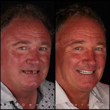 Crafted by the experts at Dentzz Mumbai, this transformation for our New  Zealand based client reflects the true art of recreating a natural, radiant  smile. #Dentzz #DentzzMumbai #Smilemakeovers #DentzzReviews  #CosmeticDentistMumbai #DentalImplantsIndia