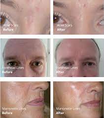 Amalian dermal fillers are manufactured in germany and underlie strict quality control. Amalian Monophasic Soft Gel Fillers 4t Medical