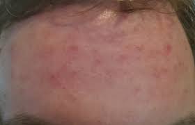 Det kan komme som en reaksjon på noe. Utslett Kviser I Pannen I Voksen Alder Helse Diskusjon No