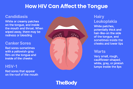 Image result for yellow tongue infection