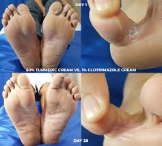 turmeric vs clotrimazole cream for