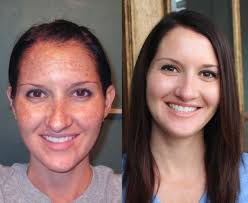 My Skin Transformation Before After Obagi Medical Products We Carry These Wonderful Products Obagi Skin Care Beauty Hacks Skincare Skin Remedies