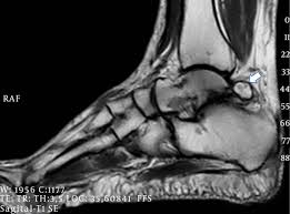 An Unusual Os Trigonum Syndrome Case Secondary To Car Accident A Case Report Middle East Journal Of Rehabilitation And Health Studies Full Text