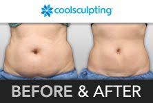 Before After Coolsculpting Cool Sculpting Sagging Skin Saggy Skin