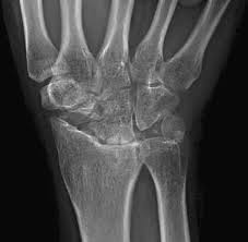 Image result for Wrist XRay