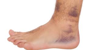How to know if you sprained your big toe? The Possible Causes Of Feet Discoloration Superior Foot Ankle Care Center