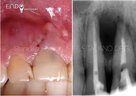 Image result for Periapical Block