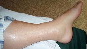 If you massively nerf damage and don't reduce hp bloat on bosses, you really hurt the number of skills that are still viable. Swollen Ankle And Leg Causes Treatments And More