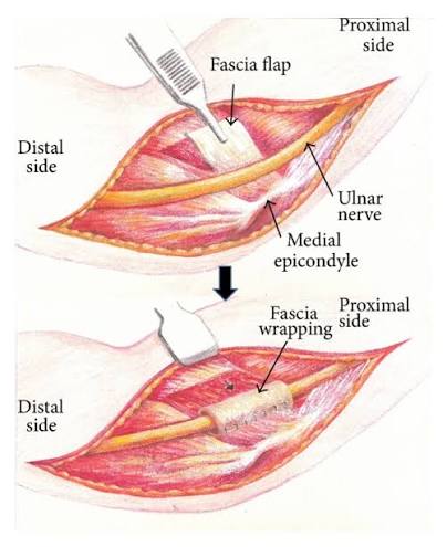 Fascia Wrapping Technique: A Modified Method for the Treatment of Cubital Tunnel Syndrome - Han - 2014 - The Scientific World Journal - Wiley Online Library