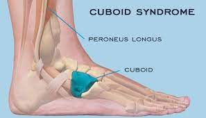 4. 5th metatarsal shaft fracture  there are several types of fractures that can affect the 5th metatarsal. Lateral Foot Pain Max Remedial Massage And Therapy