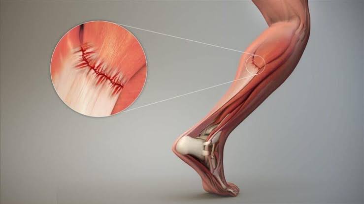 Chấn thương cơ bắp chân: Hiểu đúng để không đau lâu - Bệnh viện FV