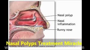 By james miller last updated april 14, 2020. Nasal Polyps Treatment Miracle Review Pros Cons My Honest Thoughts
