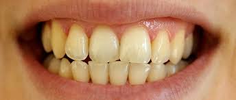 PrevDent Regenerative Teeth Whitening ...