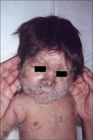 Image result for Hypertrichosis