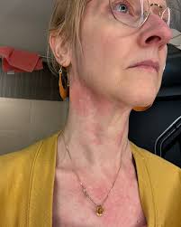 Fundraiser by Allison Carey : Allison Carey Needs Life-Saving Treatment for  MCAS