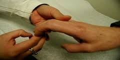 The hoffman sign is an involuntary flexion movement of the thumb and or index finger when the examiner flicks the fingernail of the middle finger down. Hoffman Sign Dnatube Com Scientific Video And Animation Site