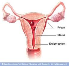 Uterine Polyps Uterine Polyps Polyps Uterus Polyps Symptoms