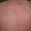 It's not clear what causes myeloma. 3