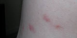 Image result for flea bites