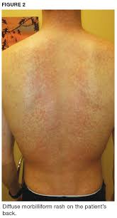 Hiv rash symptoms & when it appears. Man 25 With Sinus Pain Sore Throat And Rash Clinician Reviews