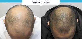10 badran kw, sand jp. Discover The Revolutionary One Off Treatment For Thinning Hair And Alopecia By Olivier Amar Cosmetic Finesse In The Heart Of London