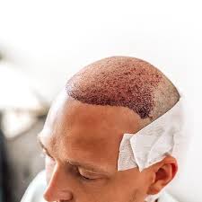 Hair Transplant in Dubai | Best Hair Clinic