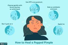 Again, don't aggressively rub at it or disrupt the forming scab. How To Heal A Popped Pimple Scab