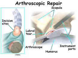 Therefore, a slap repair may be just a part of the. Labral Tears Orthogate