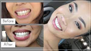 Best teeth whitening kits for at home. Teeth Whitening At Home With Hydrogren Peroxide 3 Youtube