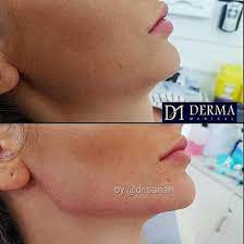 Pin On Chin Jawline Sculpting