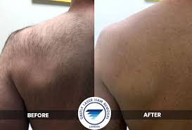 Laser hair removal provides fast removal of unwanted hair from large areas of the face and body with few side effects. Laser Hair Removal London Simply Laser Hair Removal