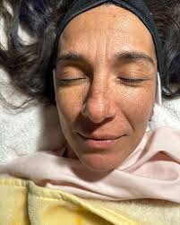 Before and after of this beauty . Derma Planning Facial with micro current  & light therapy finished off with Vitamin C jelly mask.