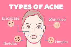 9 Best Overnight Home Remedies For Acne That Actually Work | Be Beautiful  India
