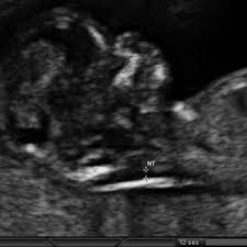 A 4d ultrasound creates a live motion video. Pdf Comparative Studies Of Two Dimensional And Three Dimensional Ultrasonic Nuchal Translucency In Trisomy Assessments