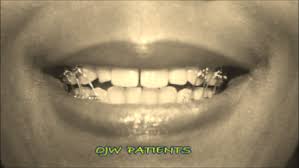 Ojw Orthodontic Jaw Wiring For Weight Control Home Facebook
