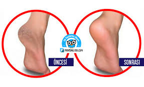 Topuklardaki Catlaklari Birkac Gunde Iyilestiren Yontem Saglik Egzersiz Cizelgesi Evde Hazirlabilen Ilaclar
