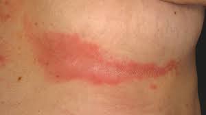 Intertrigo is a skin condition that causes a rash in folds of the skin, such as under the breasts, in the groin, or under the in this article, we describe what intertrigo is, what it looks like, and what causes it. Intertrigo Altmeyers Encyclopedia Department Dermatology