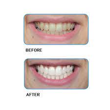 Go Smile Double Action Whitening System 12 Day Kit 24 Count Walmart Com