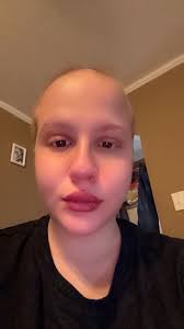 Happy Monday everyone 🌻 Has anyone else experience lymphedema in your legs  after starting Chemo? I had a small bit before starting chemo but now it's  gotten really bad. My last blood