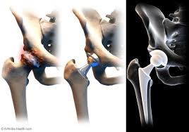 17 To Do Items Before Hip Replacement Surgery Total Hip Replacement Hip Replacement Surgery Hip Replacement