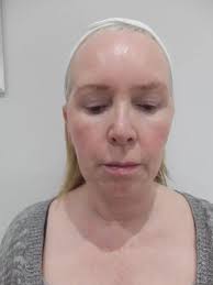 I look ten years younger” Scots woman reveals transformation after  non-surgical lunchtime face lift