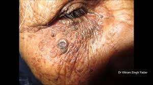 The disease was originally described in 1932 by favre 1. Favre Racouchot Syndrome Youtube