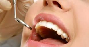 Maybe you would like to learn more about one of these? Cara Mengobati Sakit Gigi Berlubang Cepat Secara Alami Steemkr